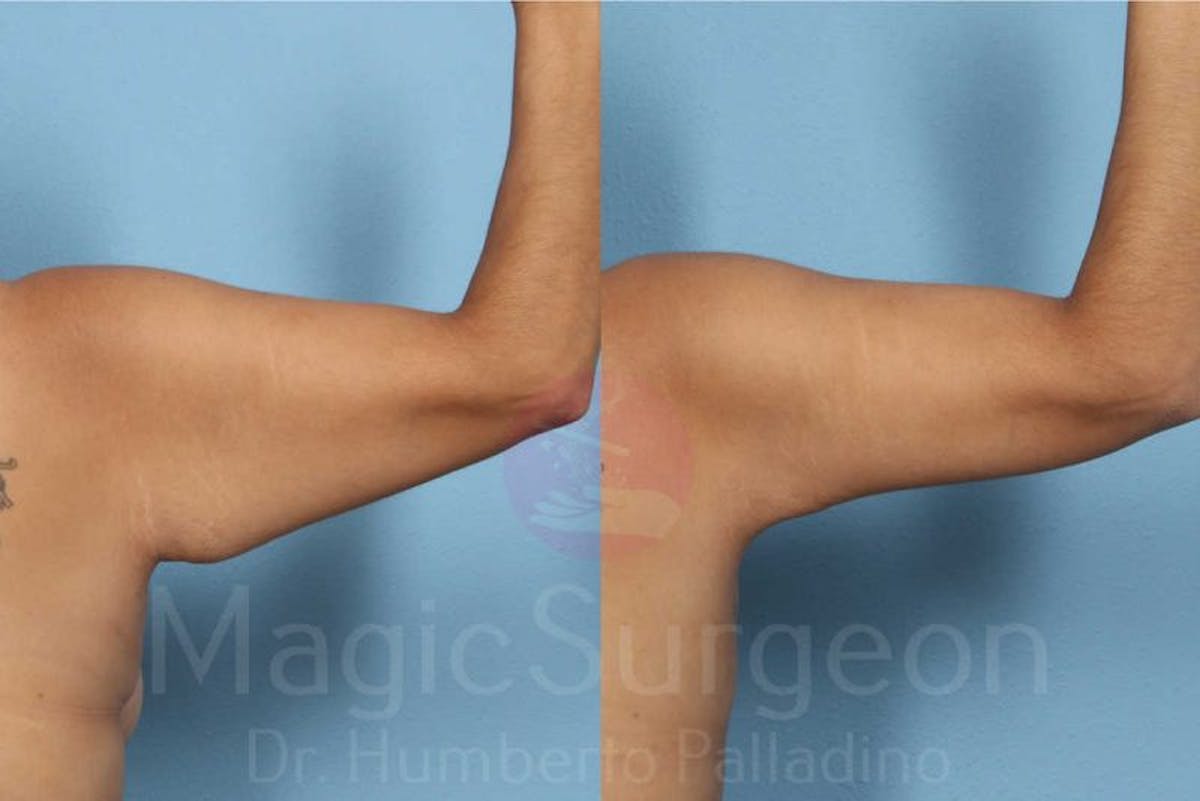 Arm Lift Before & After Gallery - Patient 133182237 - Image 2