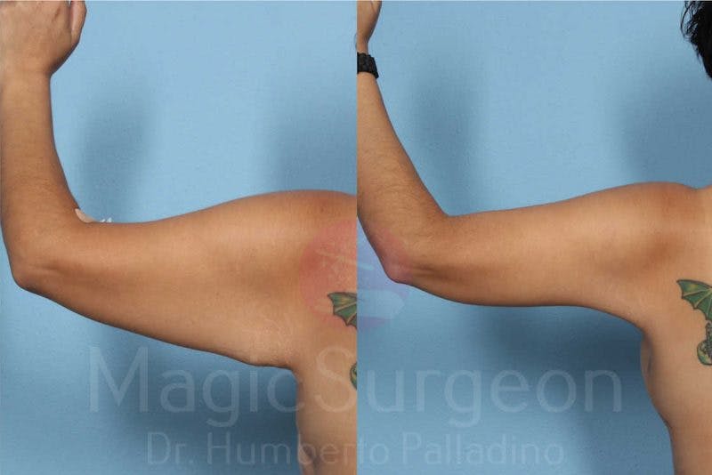 Arm Lift Before & After Gallery - Patient 133182237 - Image 3