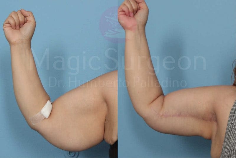 Arm Lift Before & After Gallery - Patient 133182238 - Image 1