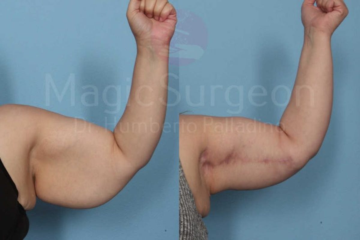 Arm Lift Before & After Gallery - Patient 133182238 - Image 2