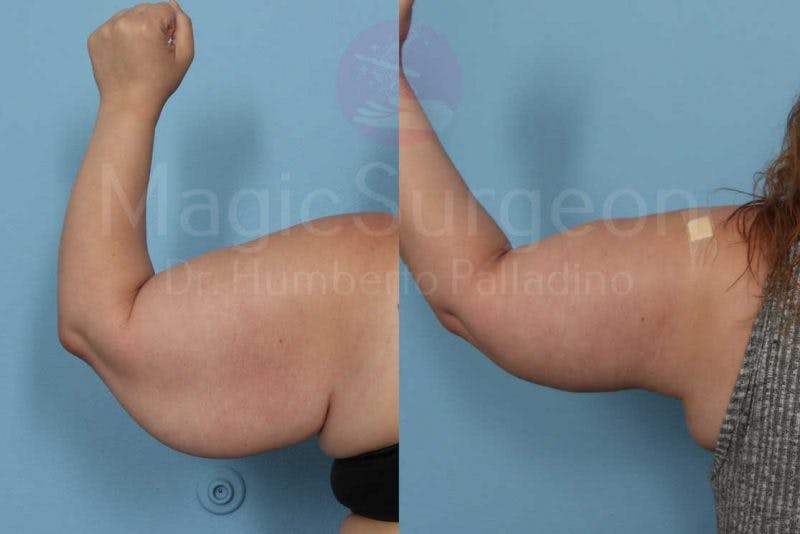 Arm Lift Before & After Gallery - Patient 133182238 - Image 3