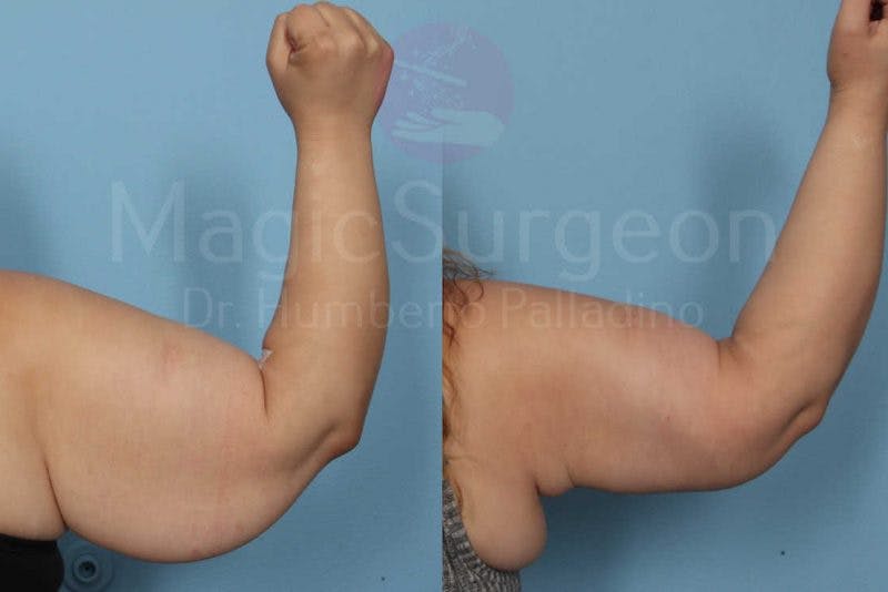 Arm Lift Before & After Gallery - Patient 133182238 - Image 4