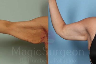 Arm Lift Before & After Gallery - Patient 133182239 - Image 1