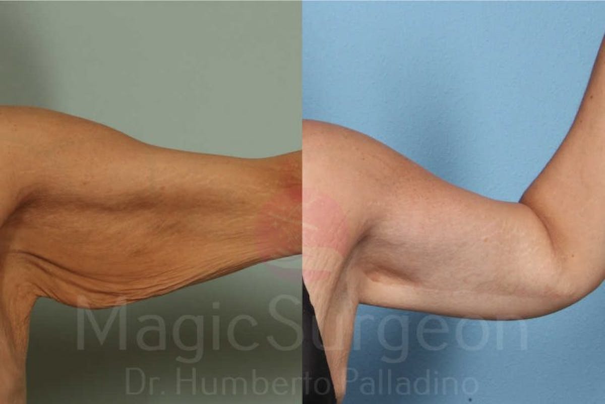 Arm Lift Before & After Gallery - Patient 133182239 - Image 2