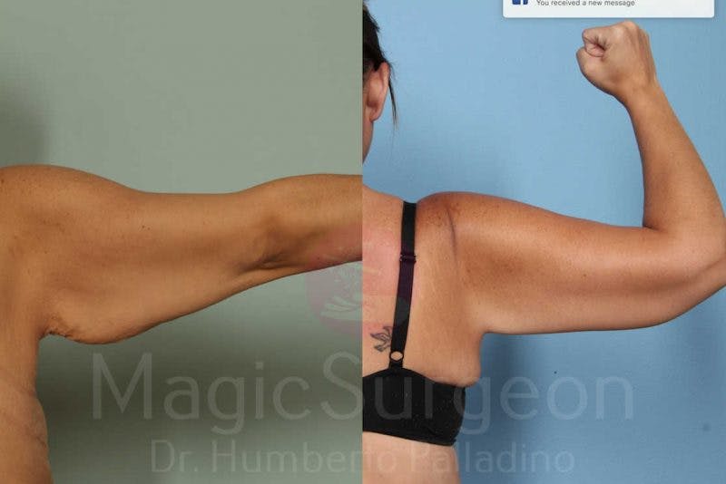 Arm Lift Before & After Gallery - Patient 133182239 - Image 3
