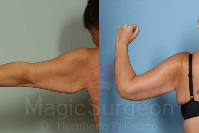 Arm Lift Before & After Gallery - Patient 133182239 - Image 4