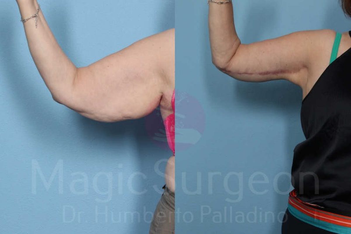 Arm Lift Before & After Gallery - Patient 133182240 - Image 1