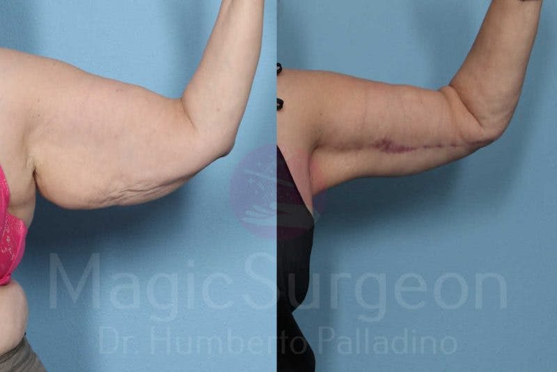 Arm Lift Before & After Gallery - Patient 133182240 - Image 2