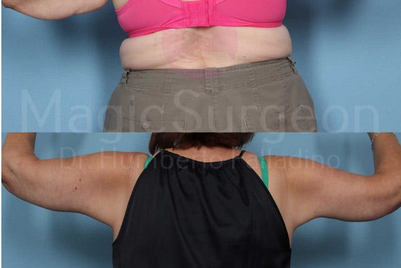 Arm Lift Before & After Gallery - Patient 133182240 - Image 3