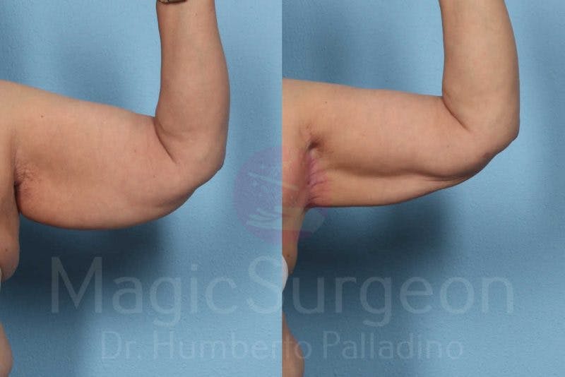 Arm Lift Before & After Gallery - Patient 133182241 - Image 2