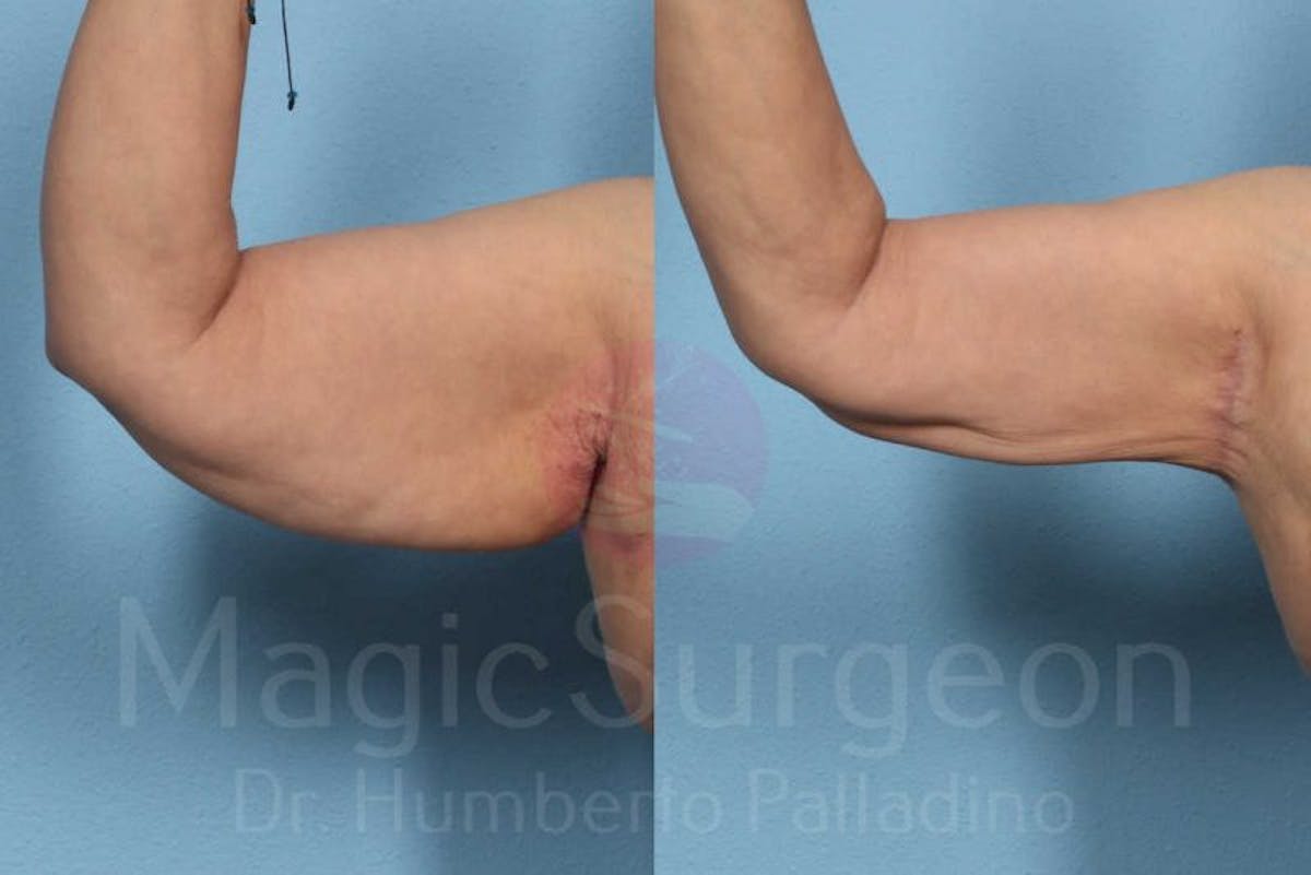 Arm Lift Before & After Gallery - Patient 133182241 - Image 1