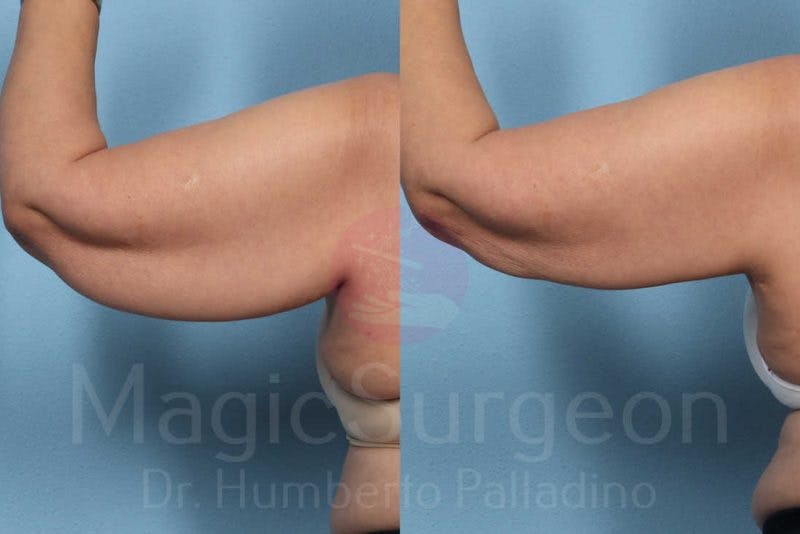 Arm Lift Before & After Gallery - Patient 133182241 - Image 3
