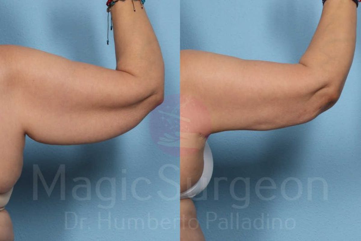 Arm Lift Before & After Gallery - Patient 133182241 - Image 4