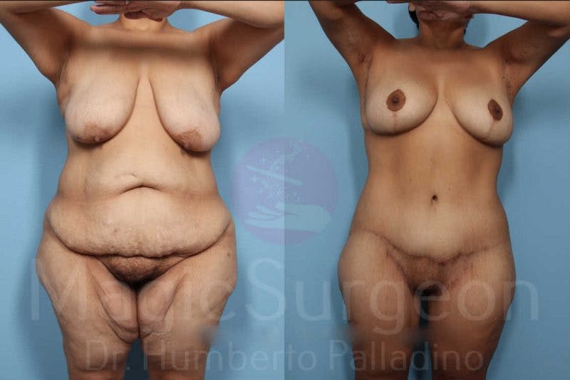Body Contouring Before & After Gallery - Patient 133182246 - Image 1