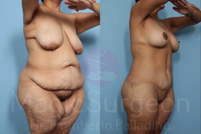 Body Contouring Before & After Gallery - Patient 133182246 - Image 2