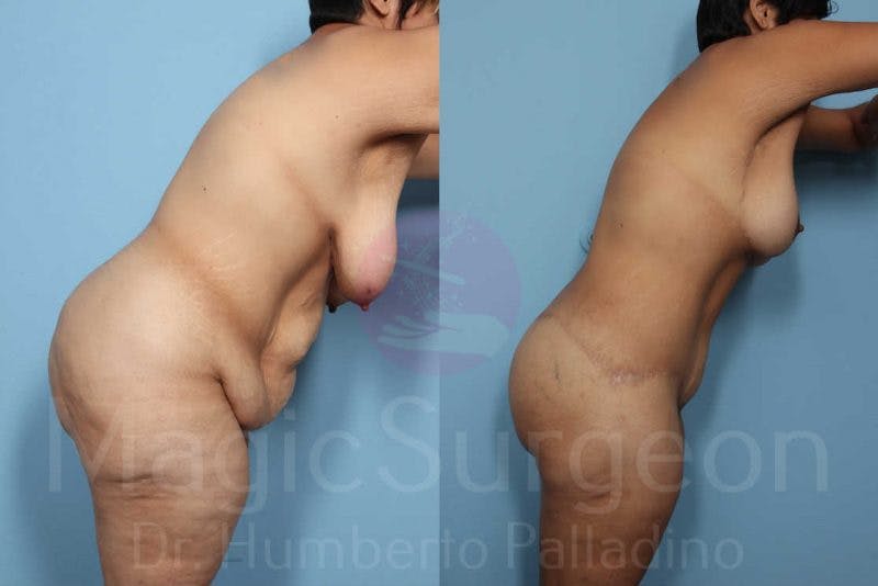 Body Contouring Before & After Gallery - Patient 133182246 - Image 3