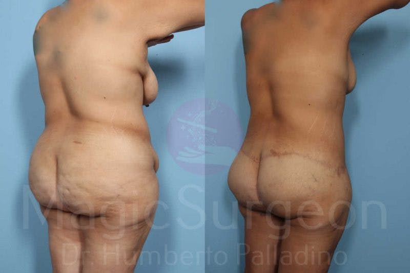 Body Contouring Before & After Gallery - Patient 133182246 - Image 4