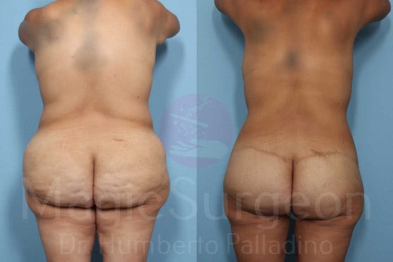 Body Contouring Before & After Gallery - Patient 133182246 - Image 5
