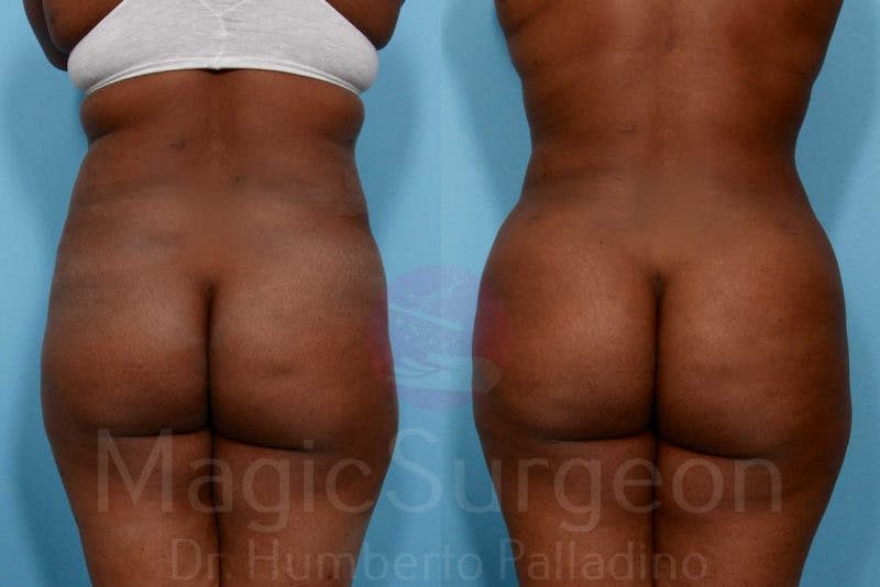 Brazilian Butt Lift Before & After Gallery - Patient 133182281 - Image 1