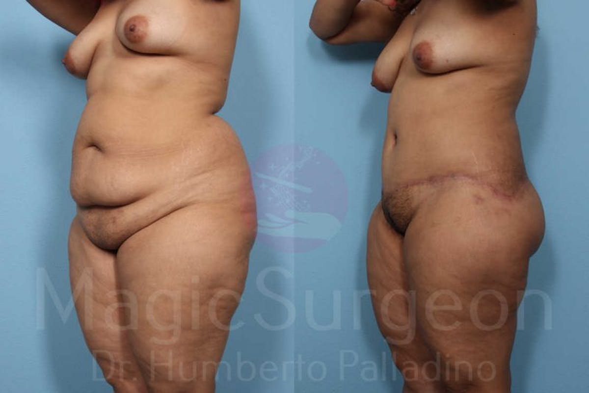 Body Contouring Before & After Gallery - Patient 133182283 - Image 2