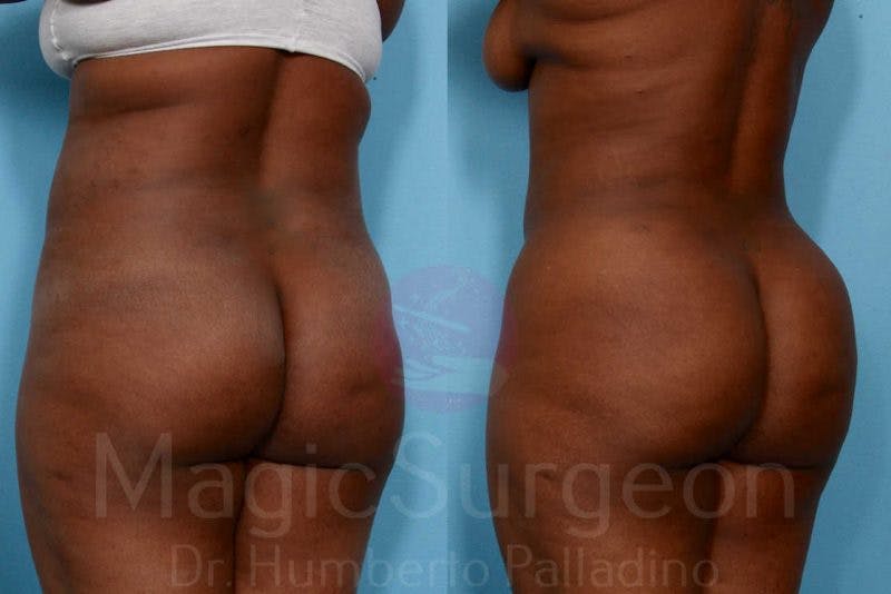 Brazilian Butt Lift Before & After Gallery - Patient 133182281 - Image 2