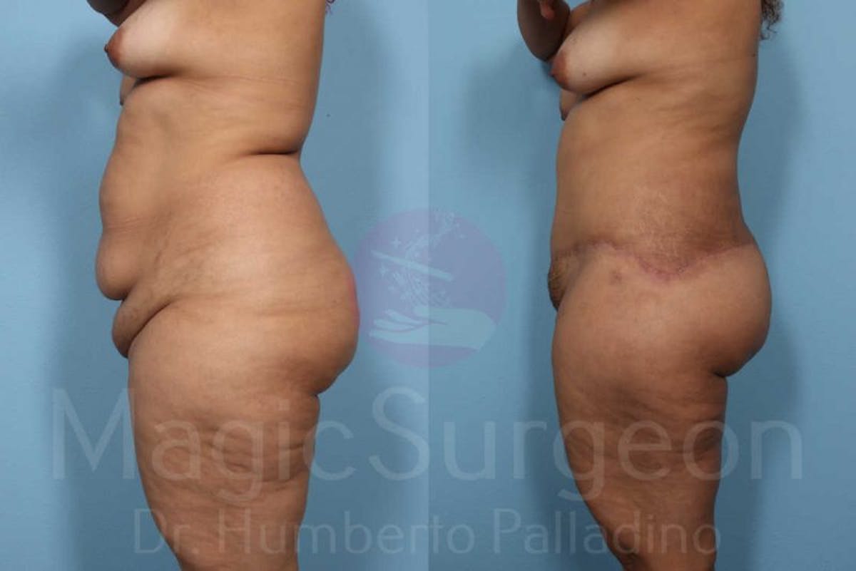 Body Contouring Before & After Gallery - Patient 133182283 - Image 3