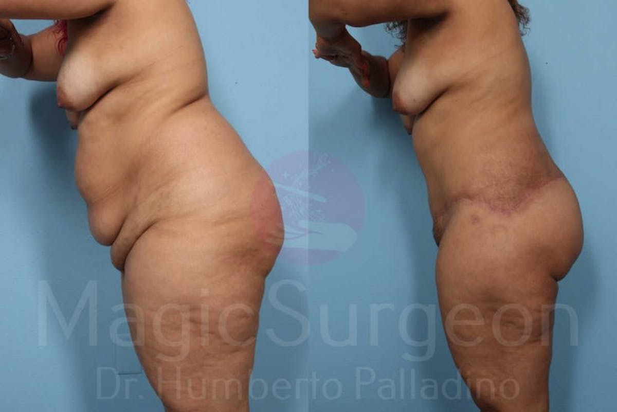 Body Contouring Before & After Gallery - Patient 133182283 - Image 4
