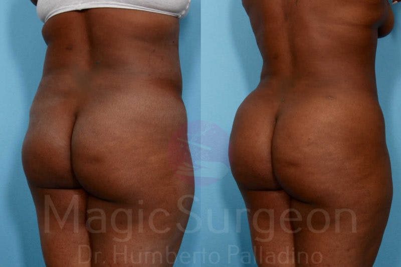 Brazilian Butt Lift Before & After Gallery - Patient 133182281 - Image 4