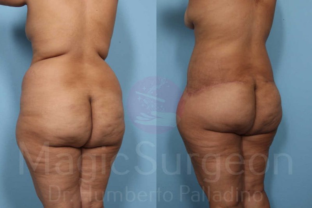Body Contouring Before & After Gallery - Patient 133182283 - Image 5