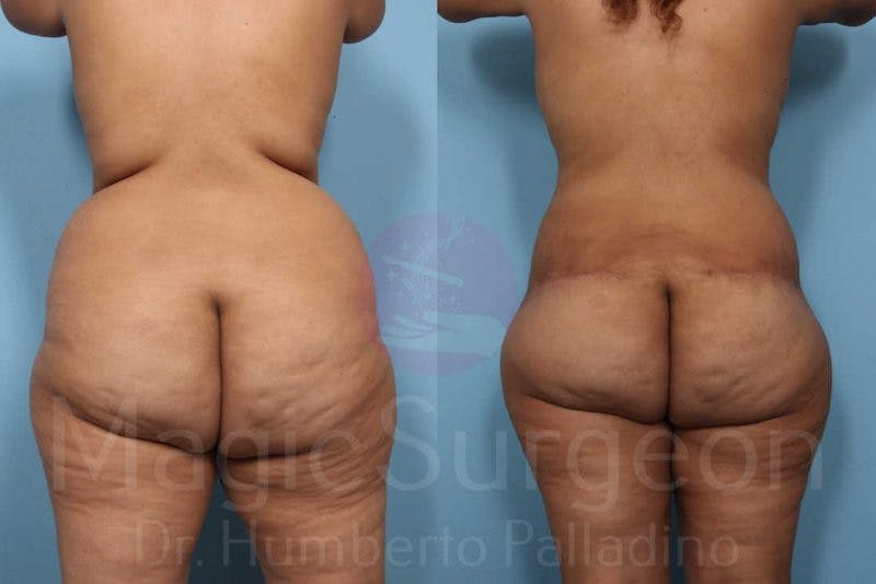 Body Contouring Before & After Gallery - Patient 133182283 - Image 6