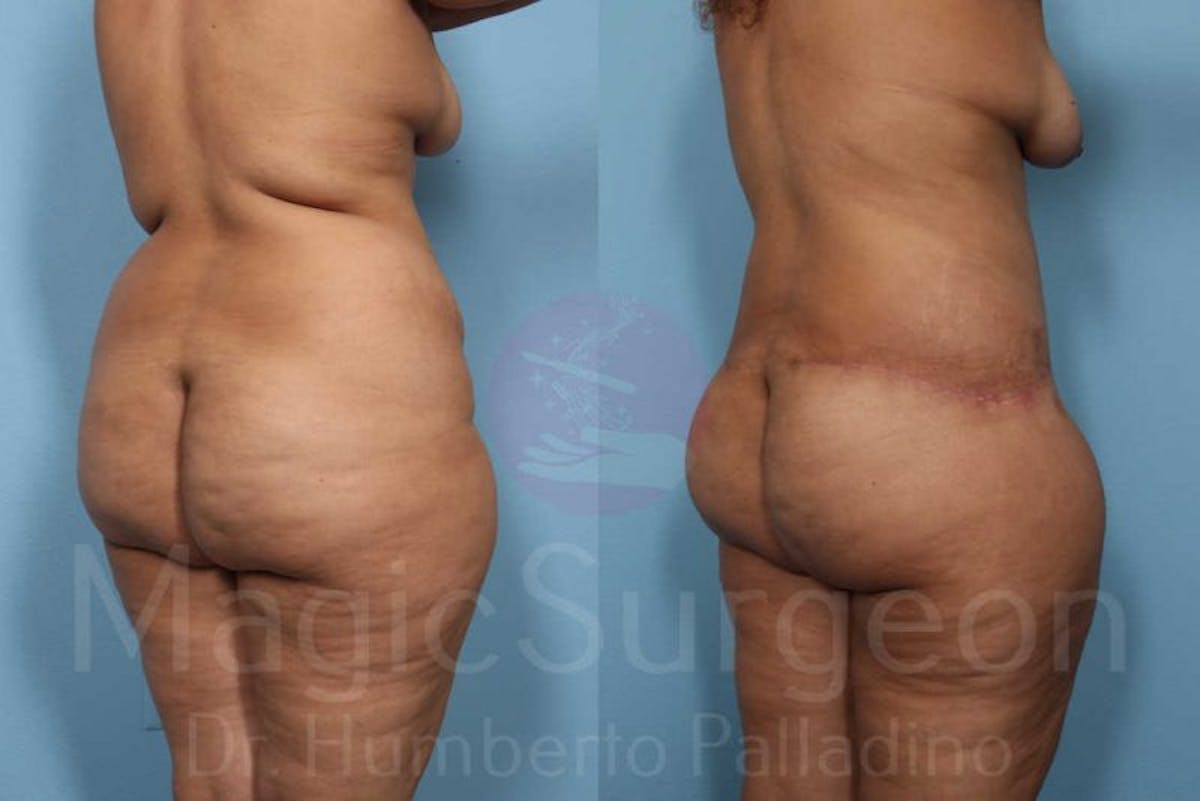Body Contouring Before & After Gallery - Patient 133182283 - Image 7