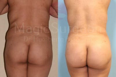 Brazilian Butt Lift Before & After Gallery - Patient 133182282 - Image 1