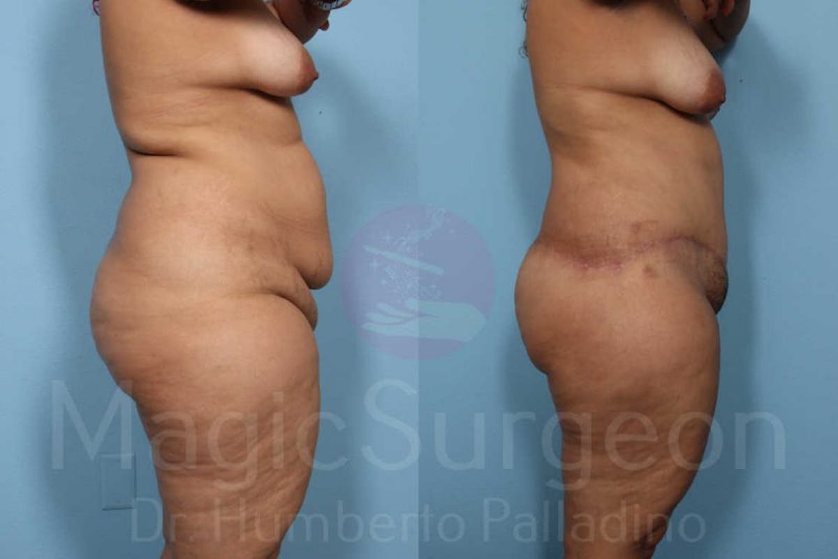 Body Contouring Before & After Gallery - Patient 133182283 - Image 8