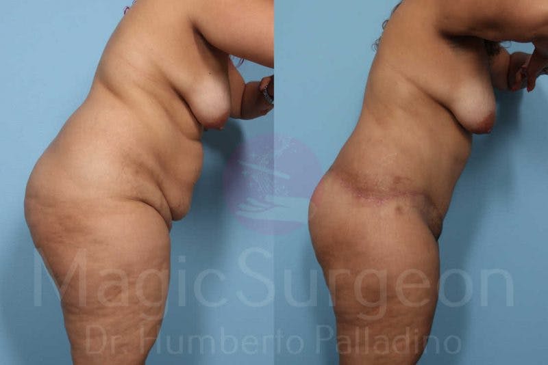 Body Contouring Before & After Gallery - Patient 133182283 - Image 9