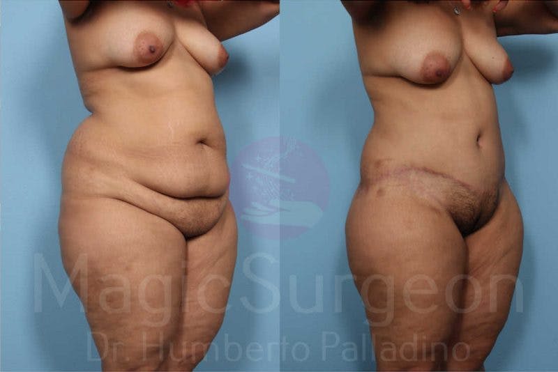 Body Contouring Before & After Gallery - Patient 133182283 - Image 10