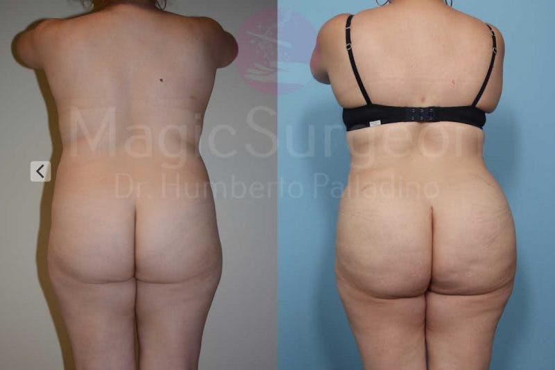 Brazilian Butt Lift Before & After Gallery - Patient 133182284 - Image 1