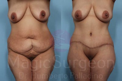 Body Contouring Before & After Gallery - Patient 133182285 - Image 1