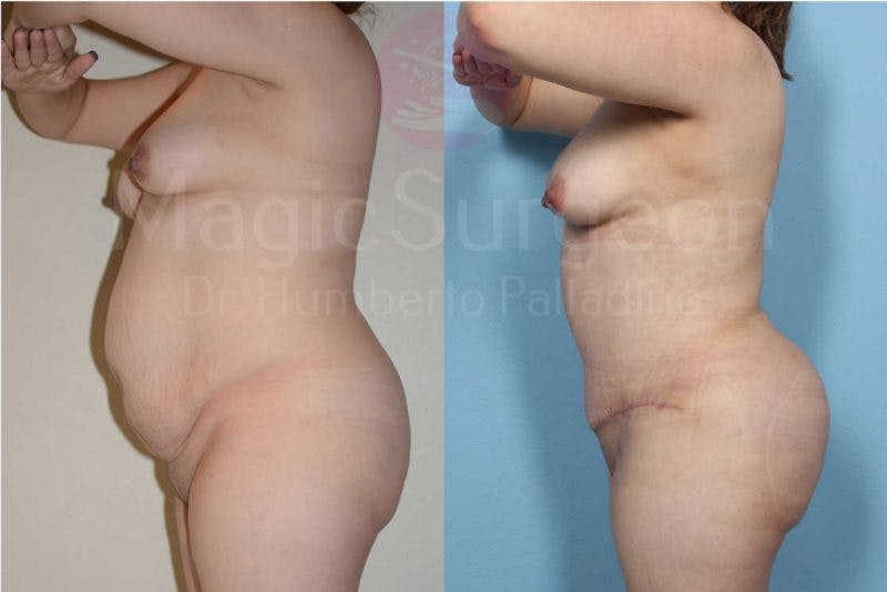 Brazilian Butt Lift Before & After Gallery - Patient 133182284 - Image 3