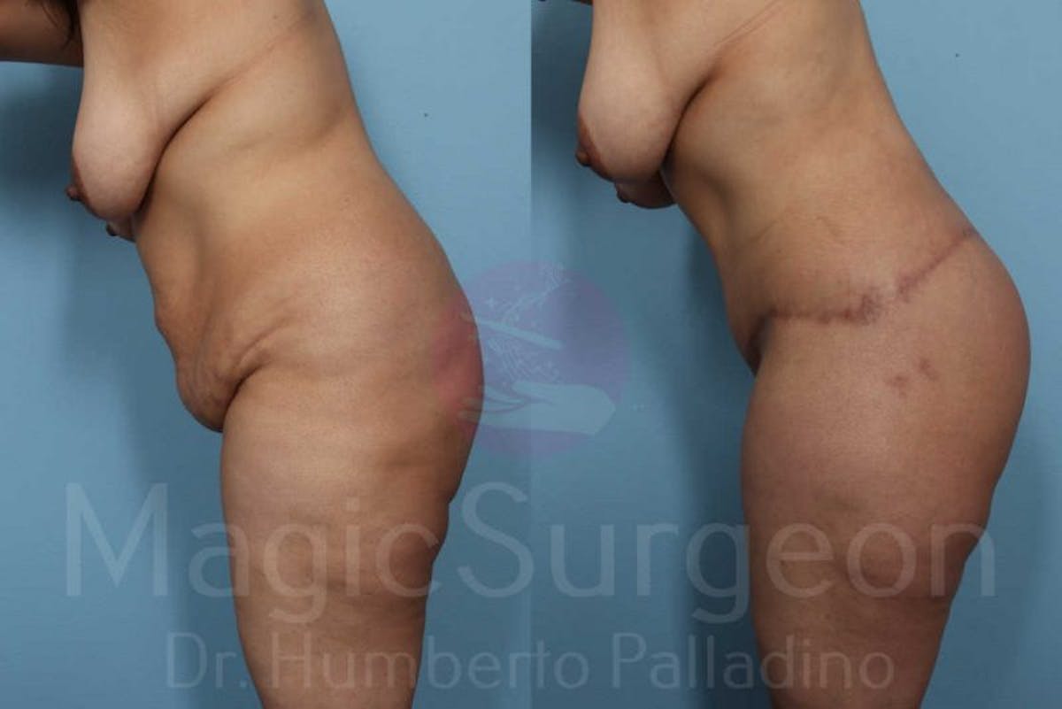 Body Contouring Before & After Gallery - Patient 133182285 - Image 3