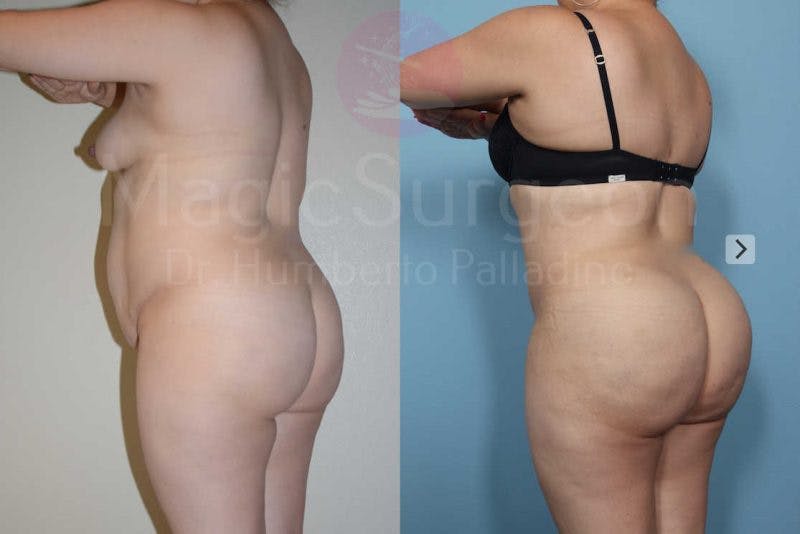 Brazilian Butt Lift Before & After Gallery - Patient 133182284 - Image 4