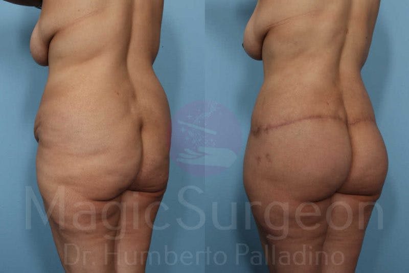 Body Contouring Before & After Gallery - Patient 133182285 - Image 4