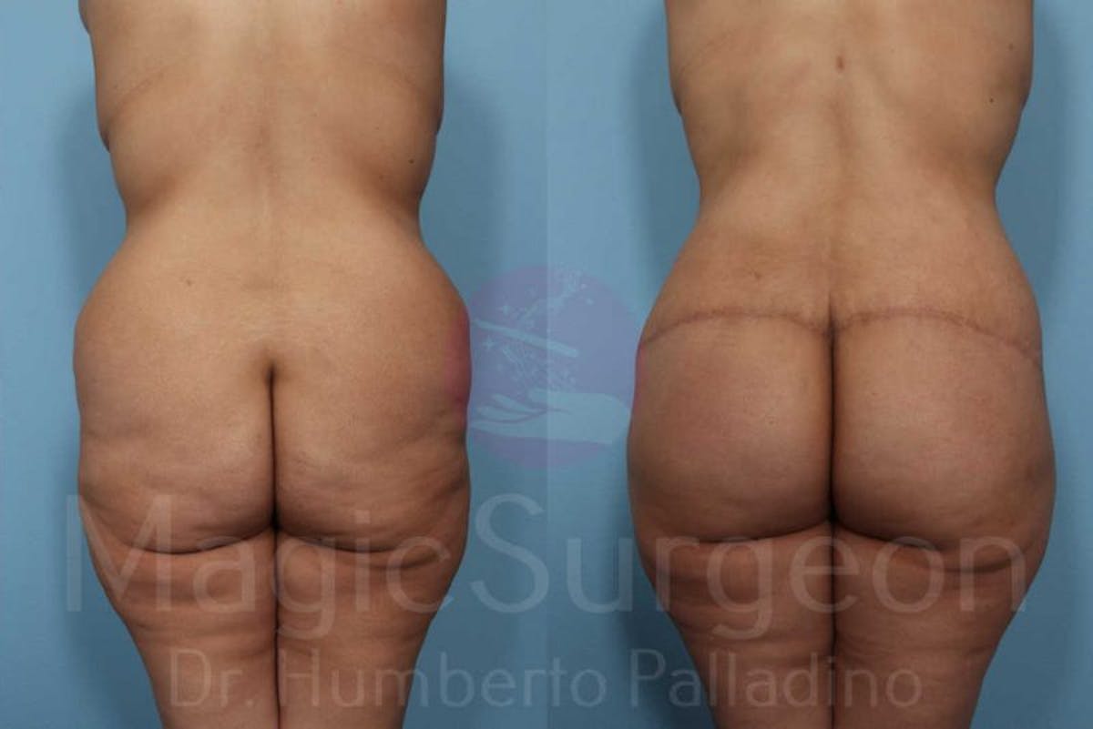 Body Contouring Before & After Gallery - Patient 133182285 - Image 5