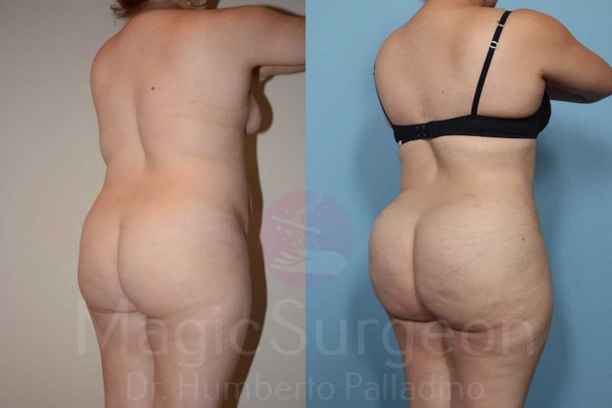 Brazilian Butt Lift Before & After Gallery - Patient 133182284 - Image 6