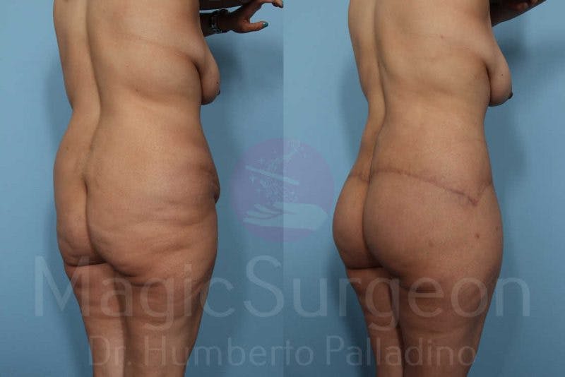 Body Contouring Before & After Gallery - Patient 133182285 - Image 6