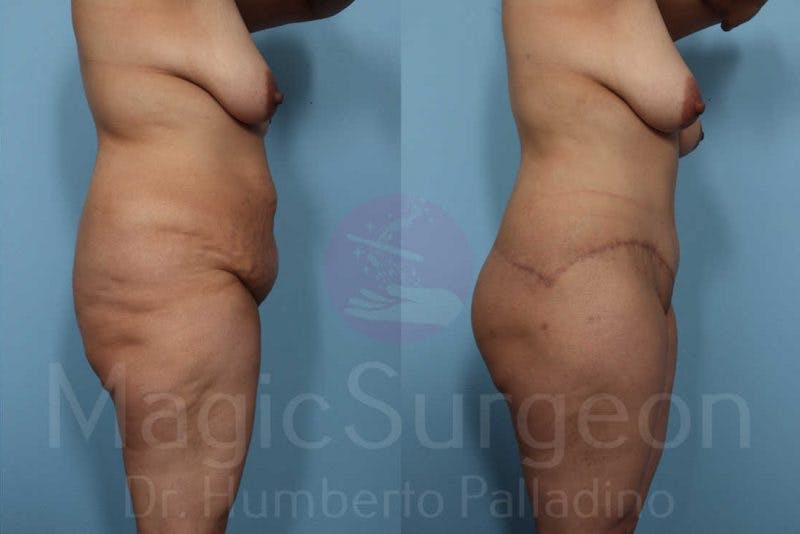 Body Contouring Before & After Gallery - Patient 133182285 - Image 7