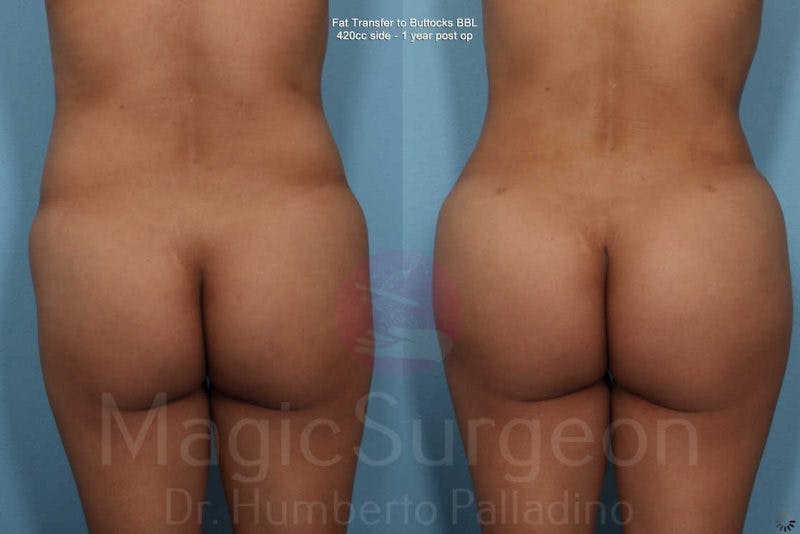 Brazilian Butt Lift Before & After Gallery - Patient 133182287 - Image 1