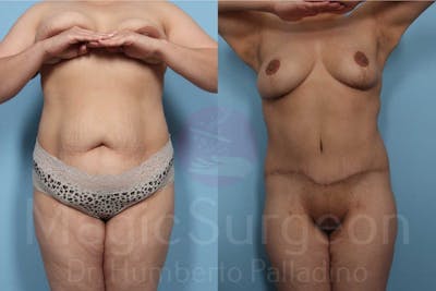 Body Contouring Before & After Gallery - Patient 133182289 - Image 1