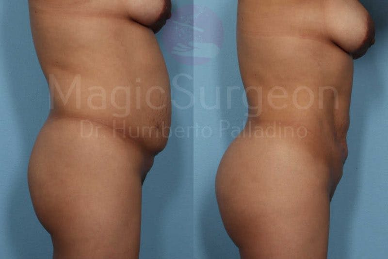 Brazilian Butt Lift Before & After Gallery - Patient 133182287 - Image 4