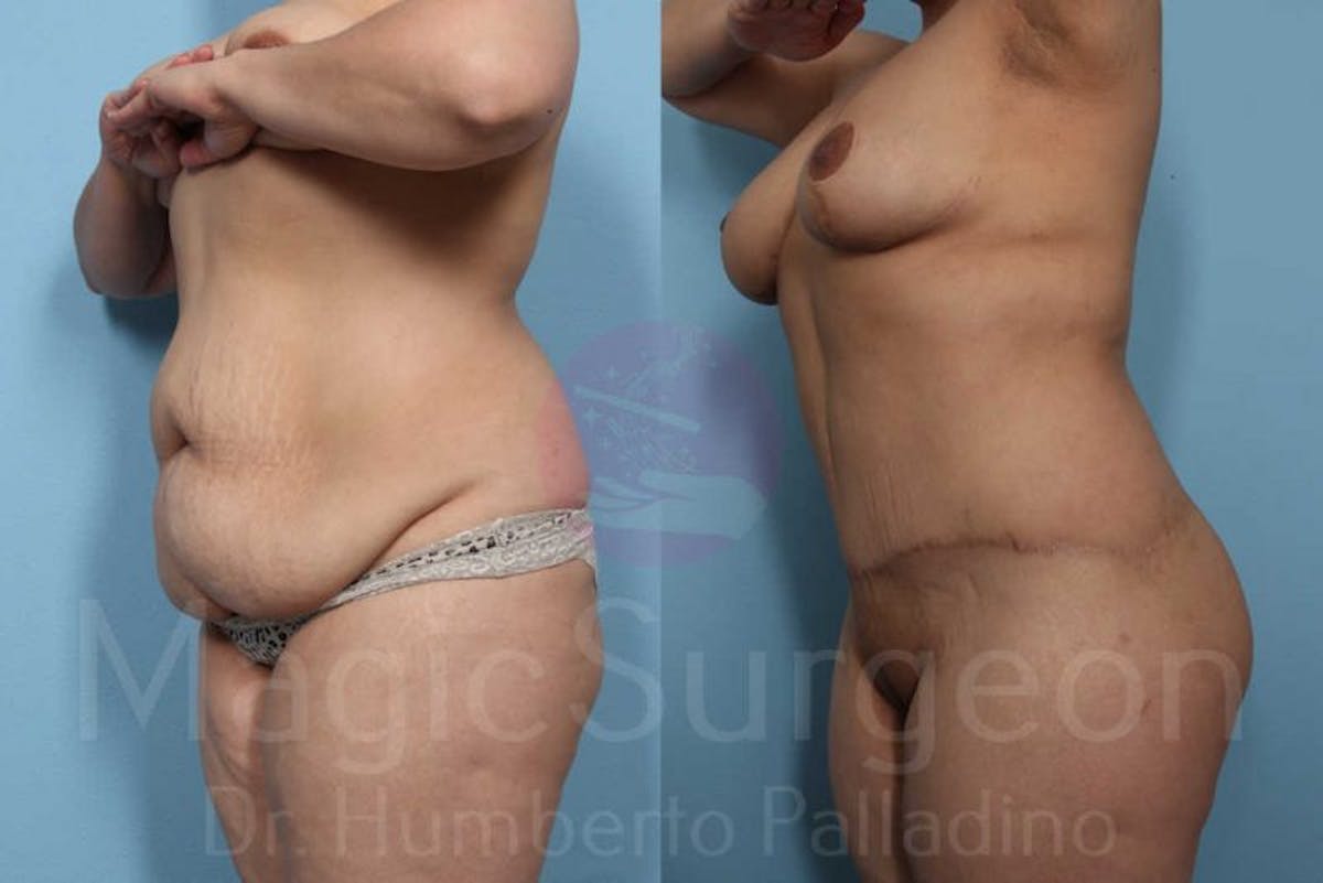 Body Contouring Before & After Gallery - Patient 133182289 - Image 2