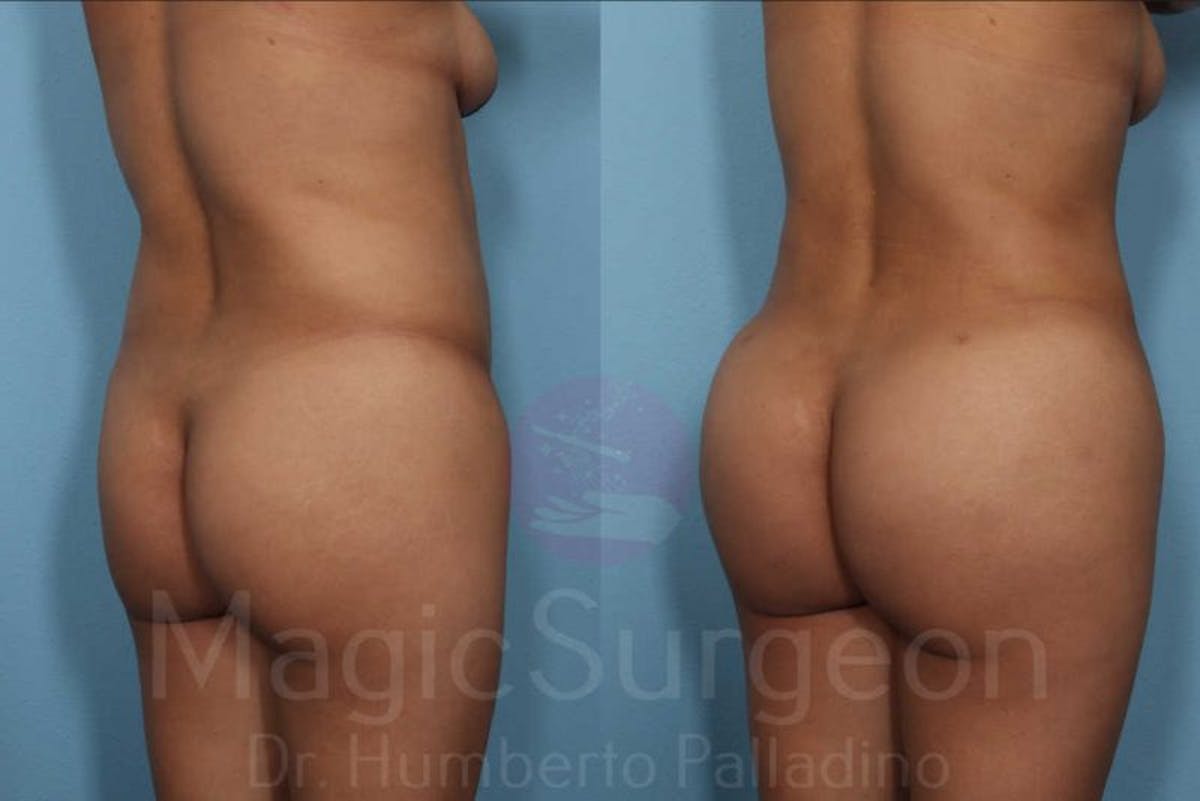 Brazilian Butt Lift Before & After Gallery - Patient 133182287 - Image 5